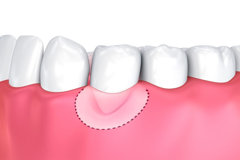 Inflamed Gums