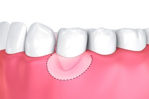 Inflamed Gums